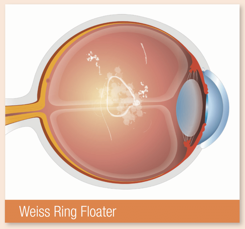 Transient Floaters Flashes and Floaters Treatment Clinton Township MI