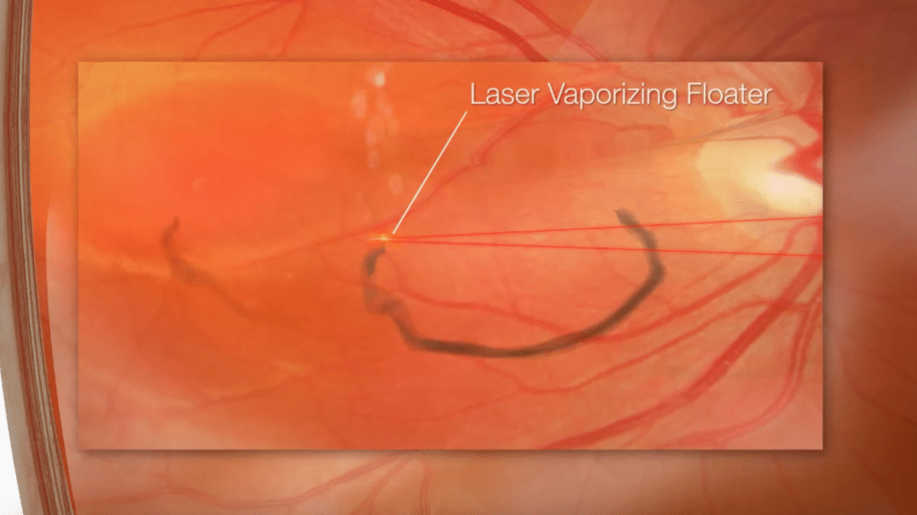 AnimationLaser Vitreolysis Lakeside Ophthalmology Center.