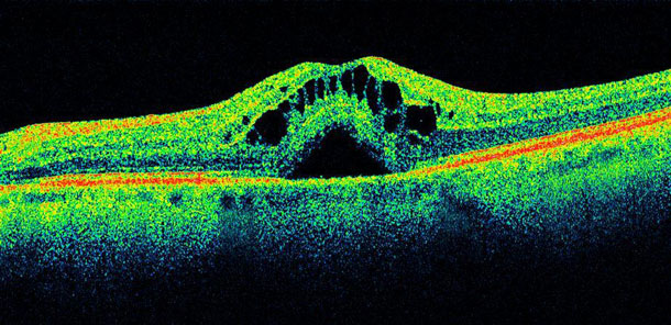 OCT demonstrating swelling of the macula - Lakeside Ophthalmology Center.